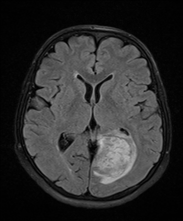 Hypertensive intracerebral hemorrhage | Image | Radiopaedia.org