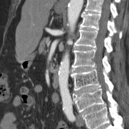 Median Arcuate Ligament Syndrome Image