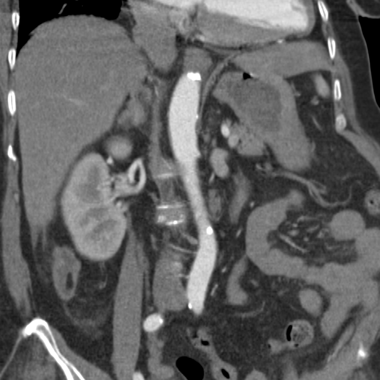 Median Arcuate Ligament Syndrome Image