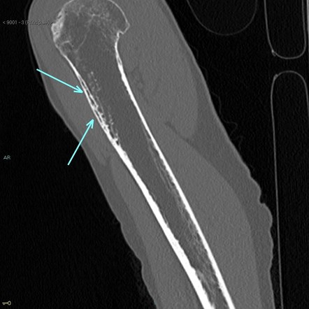 Intraosseous haemangioma | Radiology Case | Radiopaedia.org