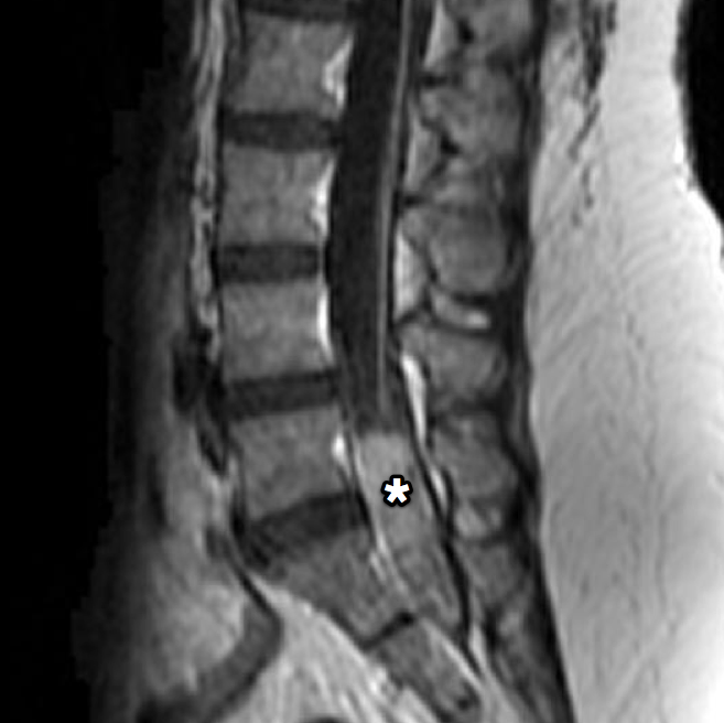 Myxopapillary ependymoma (hemorrhagic) | Image | Radiopaedia.org