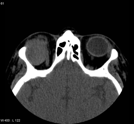 Multiple Myeloma - Orbit | Radiology Case | Radiopaedia.org