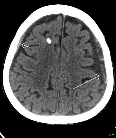 Subdural hemorrhage | Radiology Reference Article | Radiopaedia.org