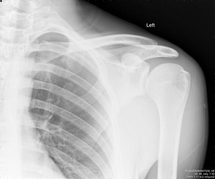 Normal AP shoulder radiograph | Radiology Case | Radiopaedia.org