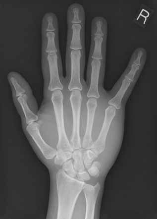 Upper limb radiography | Radiology Reference Article | Radiopaedia.org