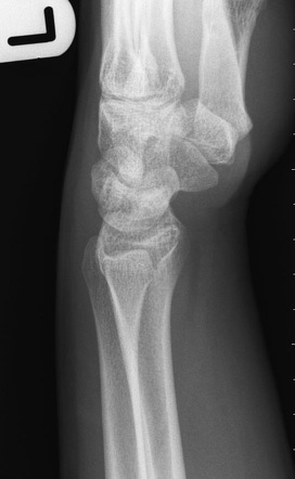 Normal lateral wrist radiograph | Radiology Case | Radiopaedia.org