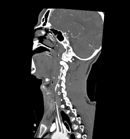 Variant course of the left vertebral artery | Radiology Case ...