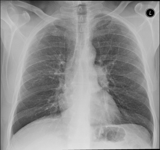 Lung cancer | Radiology Reference Article | Radiopaedia.org