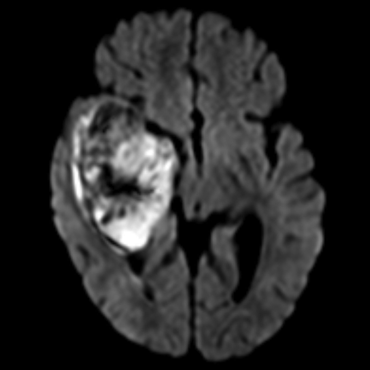 Atypical Teratoid Rhabdoid Tumor (AT/RT) | Image | Radiopaedia.org