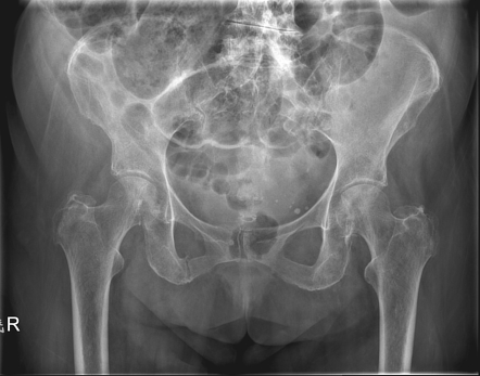 Pubic rami fracture | Image | Radiopaedia.org