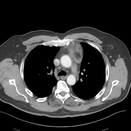 Thymolipoma | Radiology Case | Radiopaedia.org