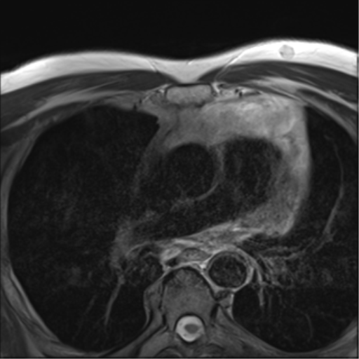 Thymolipoma | Image | Radiopaedia.org