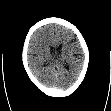 Left MCA infarct with recanalization | Image | Radiopaedia.org