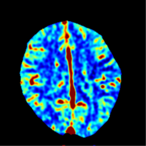 Left MCA infarct with recanalization | Image | Radiopaedia.org