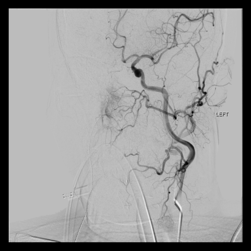 Left MCA infarct with recanalization | Image | Radiopaedia.org