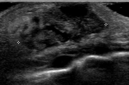 Neonatal mastitis | Radiology Reference Article | Radiopaedia.org