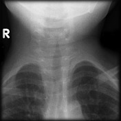 Steeple sign (trachea), Radiology Reference Article