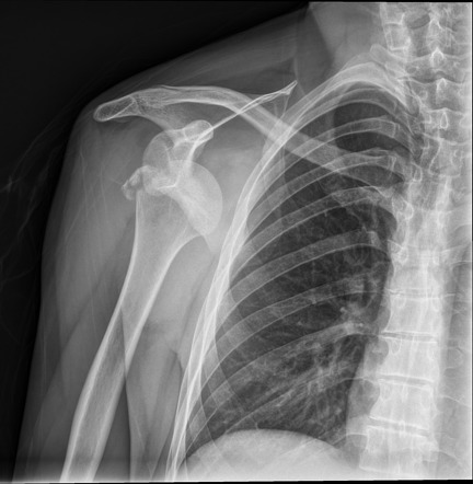 Humeral greater tuberosity fracture Radiology Case Radiopaedia