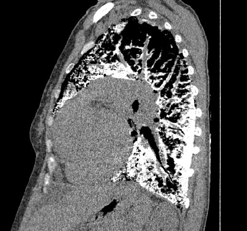 Pulmonary Alveolar Microlithiasis Image