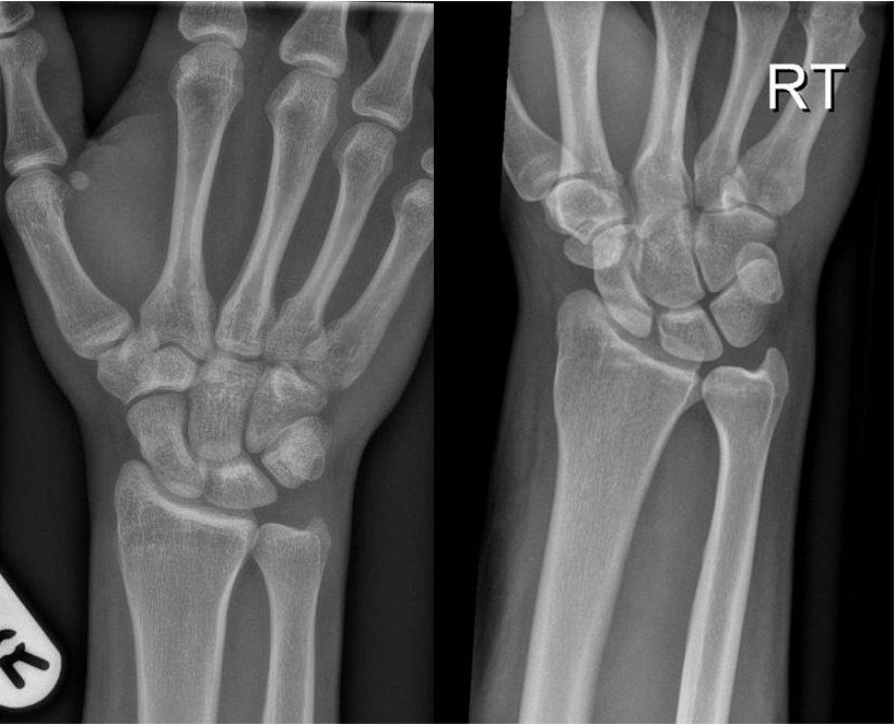 Trapezoid dislocation | Image | Radiopaedia.org