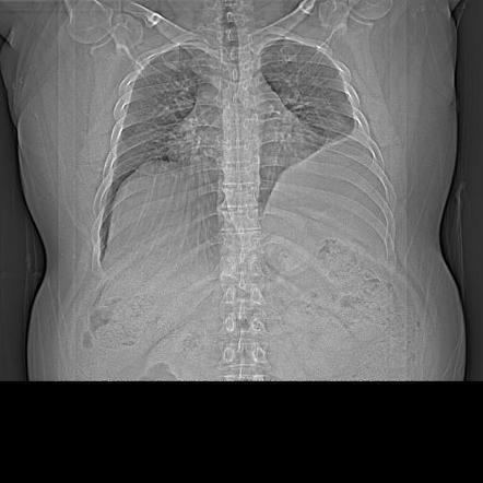 Diaphragmatic rupture | Image | Radiopaedia.org