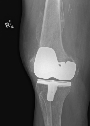 Distal Femoral Periprosthetic Fracture | Radiology Case | Radiopaedia.org