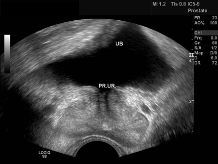 Prostatic abscess (TRUS) | Radiology Case | Radiopaedia.org