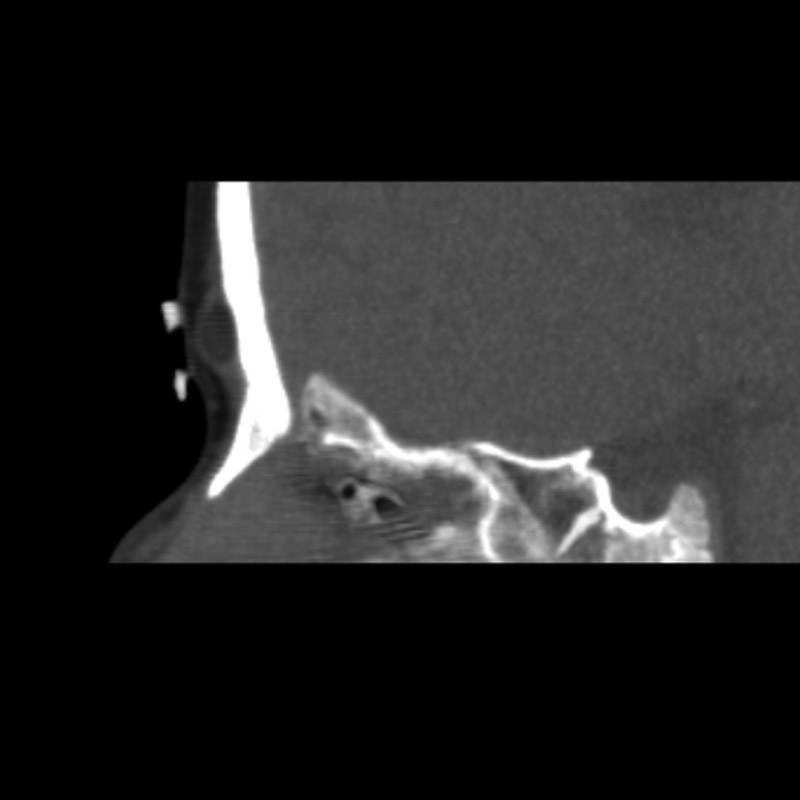 Nasal Dermoid Image 5054