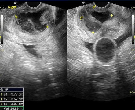 Prostatic abscess | Radiology Case | Radiopaedia.org