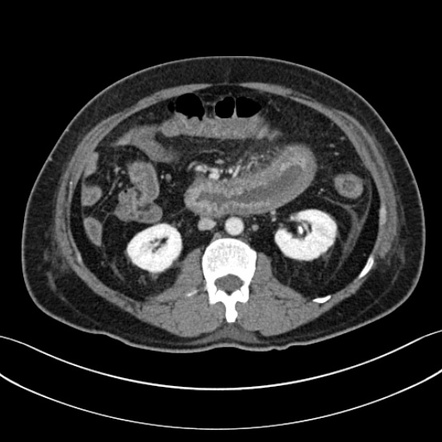 IgA vasculitis | Radiology Reference Article | Radiopaedia.org