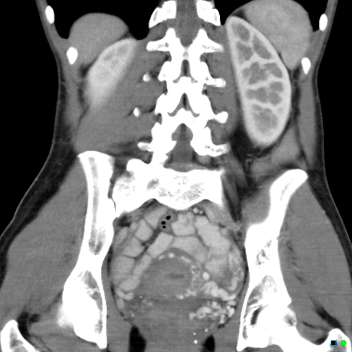 Pelvic Congestion Syndrome Image