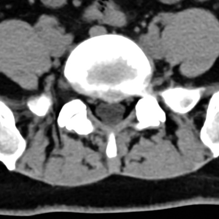 Disc Protrusion Radiology Reference Article Radiopaedia Org