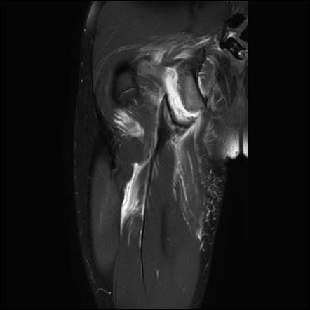 Ischial tuberosity avulsion injury | Image | Radiopaedia.org