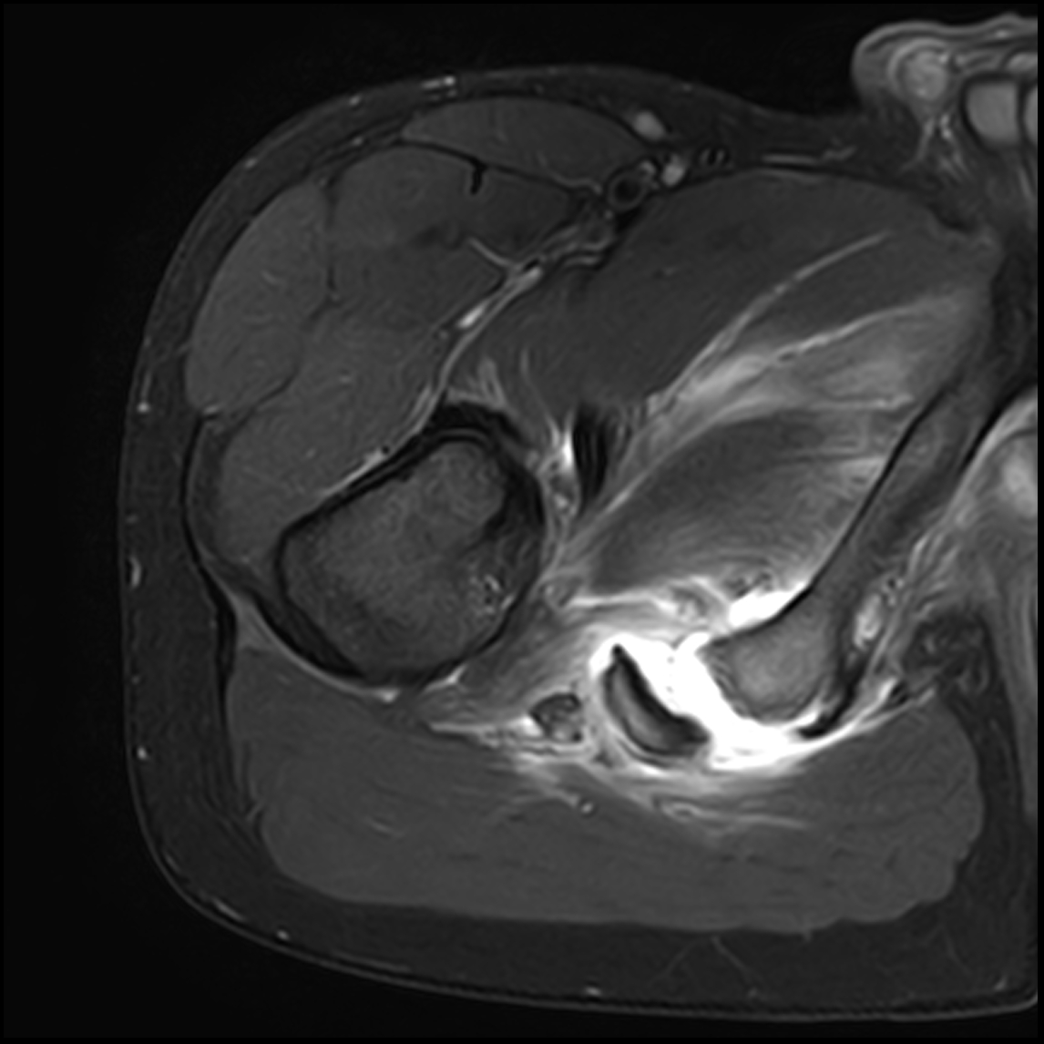 Ischial Tuberosity Avulsion Injury Image Radiopaedia Org