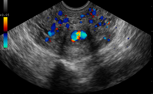 Cervical varix and low-lying placenta | Image | Radiopaedia.org