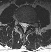 Disc extrusion | Radiology Reference Article | Radiopaedia.org