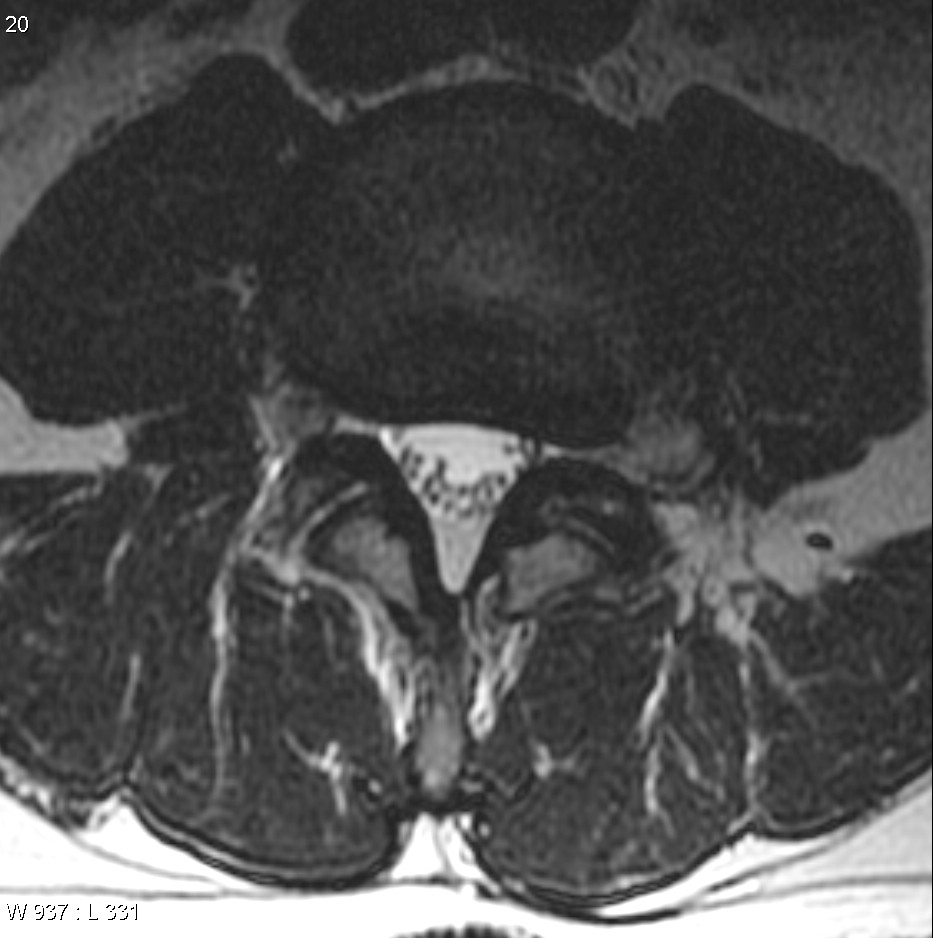 Disc extrusion - foraminal | Image | Radiopaedia.org