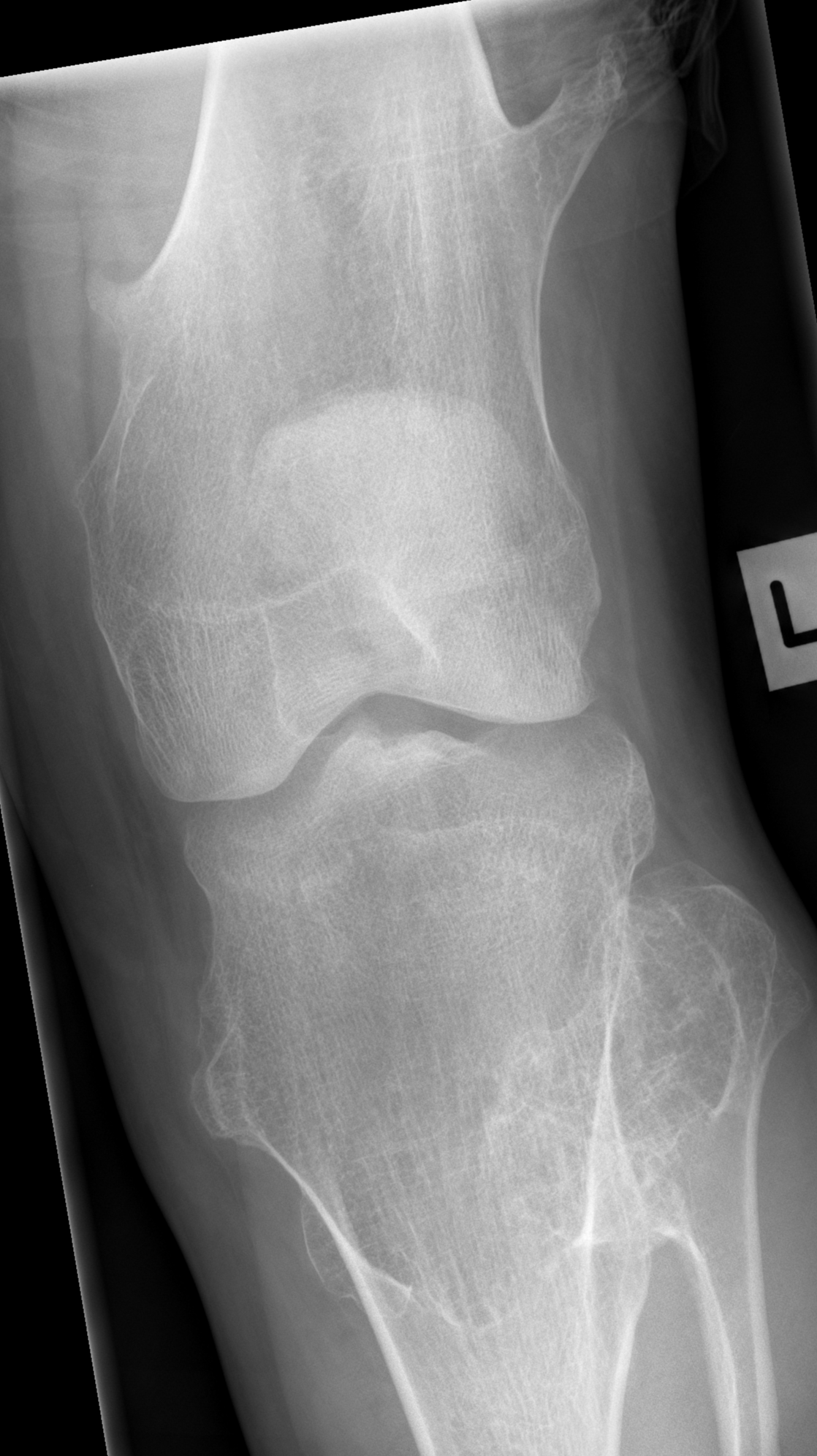 Hereditary multiple exostoses | Image | Radiopaedia.org