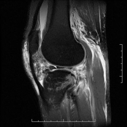 Bucket handle meniscal tear with collateral and anterior cruciate ...