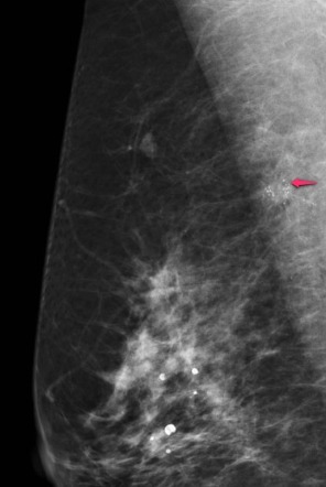 Invasive Ductal Carcinoma Ultrasound