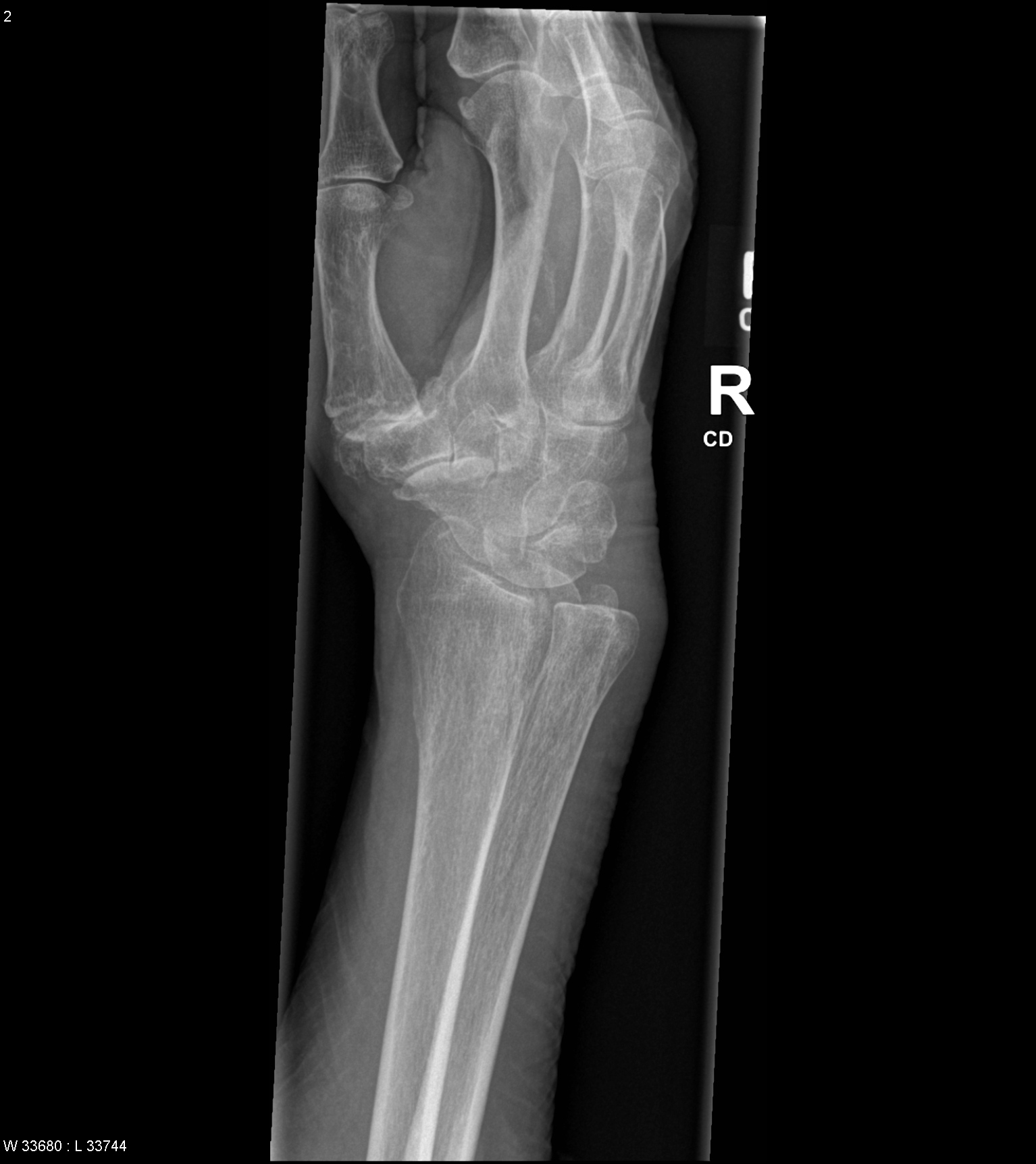 File:Distal radial fracture, triscaphe and first carpometacarpal joint ...