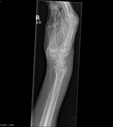 Distal radial fracture, triscaphe and first carpometacarpal joint ...