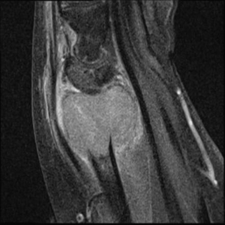 Distal Radius Giant Cell Tumor | Image | Radiopaedia.org