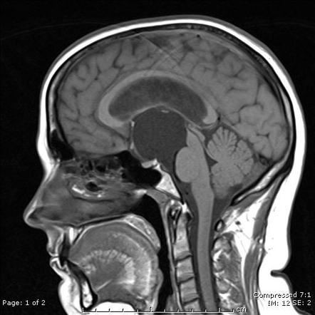 Suprasellar arachnoid cyst | Radiology Reference Article | Radiopaedia.org