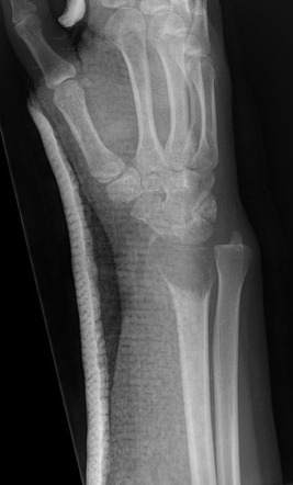 Distal Radius Giant Cell Tumor | Image | Radiopaedia.org