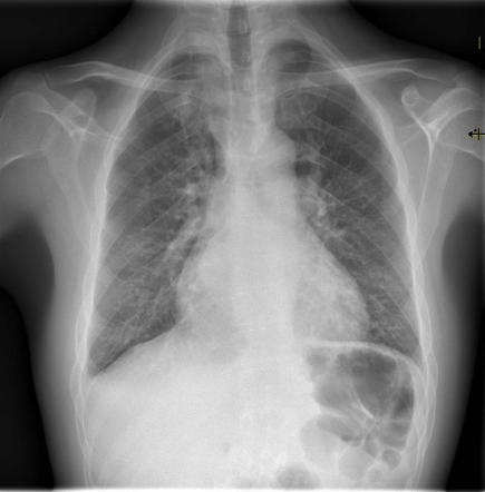 Pulmonary hypertension | Radiology Reference Article | Radiopaedia.org