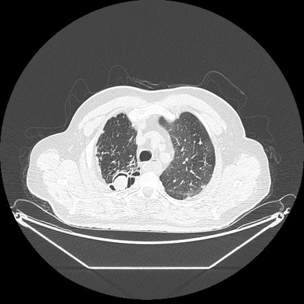 Aspergilloma | Radiology Reference Article | Radiopaedia.org