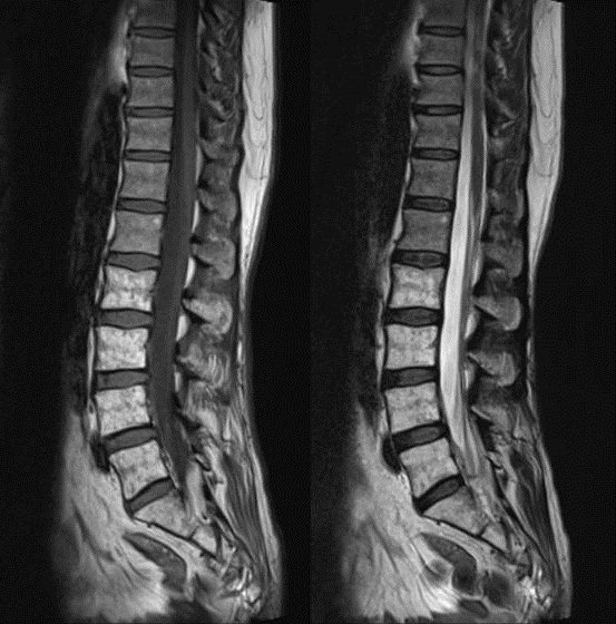 Radiation induced fatty marrow replacement | Image | Radiopaedia.org