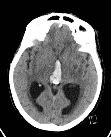 Primary Intraventricular Hemorrhage | Radiology Case | Radiopaedia.org