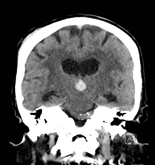 Primary Intraventricular Hemorrhage | Image | Radiopaedia.org